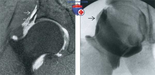 Признаки повреждения капсулярных связок тазобедренного сустава на артрограмме