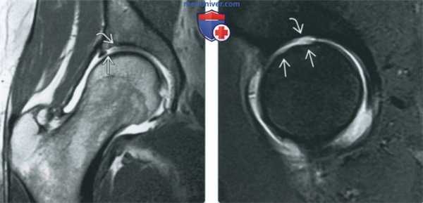 Признаки хрящевых и костно-хрящевых повреждений тазобедренного сустава на артрограмме