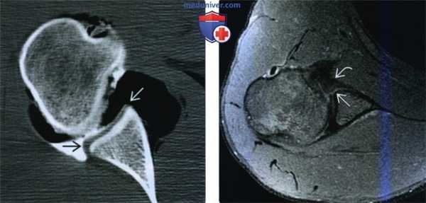 Рентгенограмма, КТ, МРТ при повреждении Банкарта