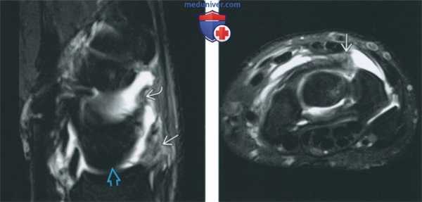 Признаки повреждения внешних связок запястья на артрограмме