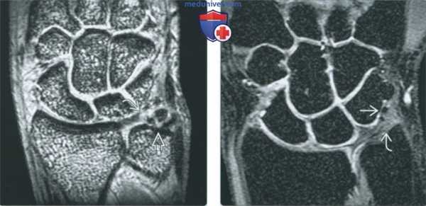 Изменения запястья после операции на артрограмме