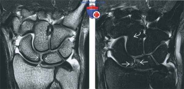 Признаки хрящевых и костно-хрящевых повреждений запястья на артрограмме