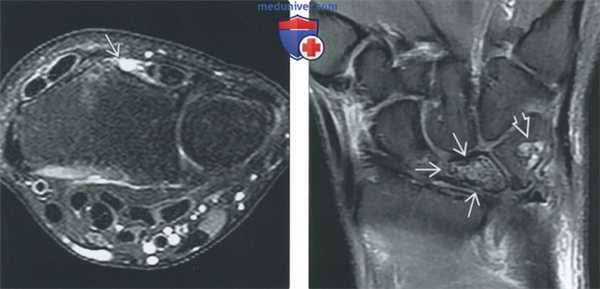 Советы по оценке МРТ артрограммы суставов запястья