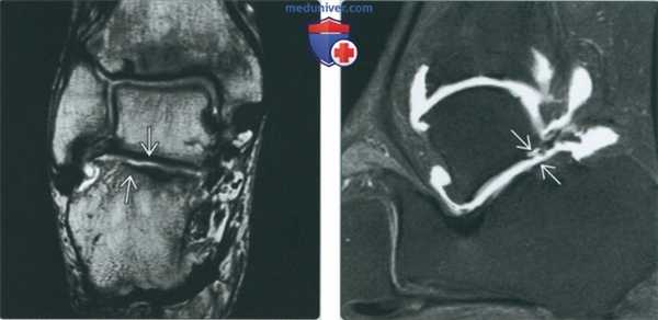 Признаки повреждений суставов стопы на артрограмме