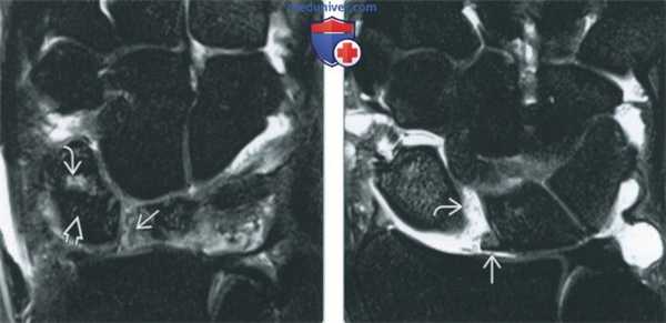 Изменения запястья после операции на артрограмме