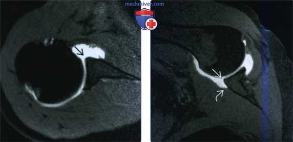 Рентгенограмма, КТ, МРТ при повреждении Банкарта