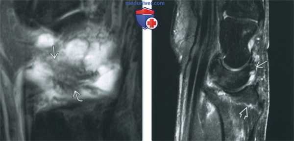 Признаки повреждения внешних связок запястья на артрограмме