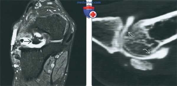 Признаки повреждений суставов стопы на артрограмме