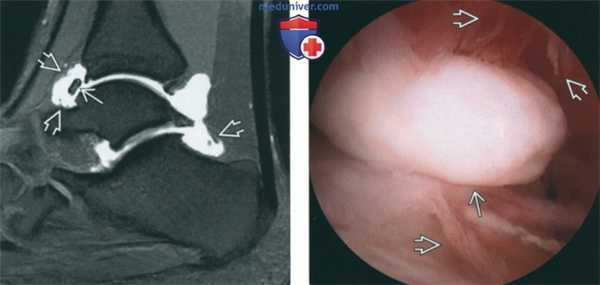 Советы по оценке МРТ артрограммы голеностопного сустава