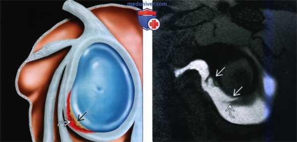 Рентгенограмма, КТ, МРТ при повреждении Банкарта