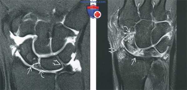 Советы по оценке МРТ артрограммы суставов запястья