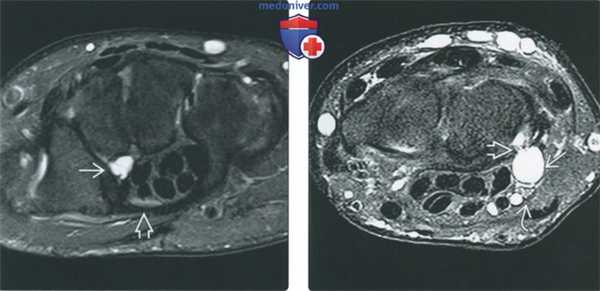 Советы по оценке МРТ артрограммы суставов запястья