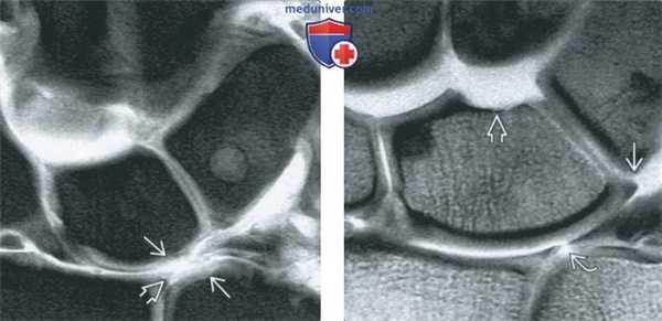 Признаки хрящевых и костно-хрящевых повреждений запястья на артрограмме