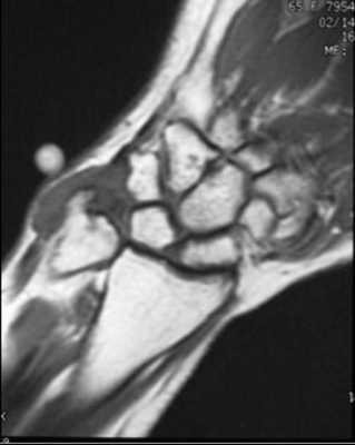 гигантоклеточная опухоль - Т1