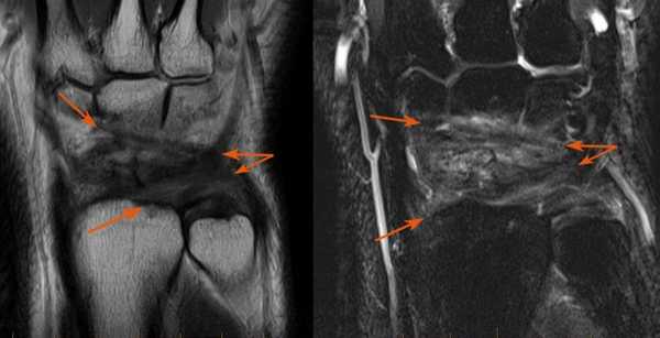 повреждение связок-обр