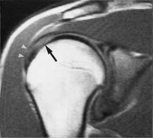 частичныйразрыв вращательной манжеты
