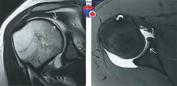Признаки хрящевых и костно-хрящевых повреждений плечевого сустава на артрограмме
