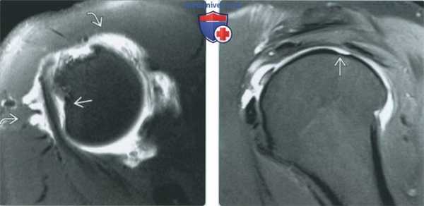 Признаки хрящевых и костно-хрящевых повреждений плечевого сустава на артрограмме