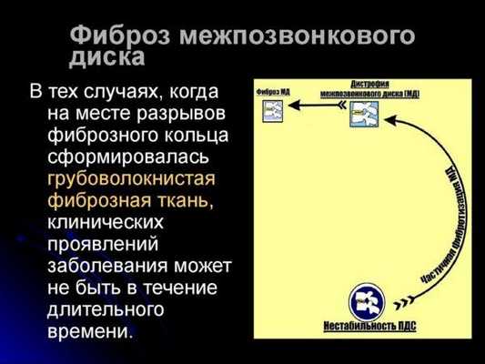 Фиброз межпозвонкового диска