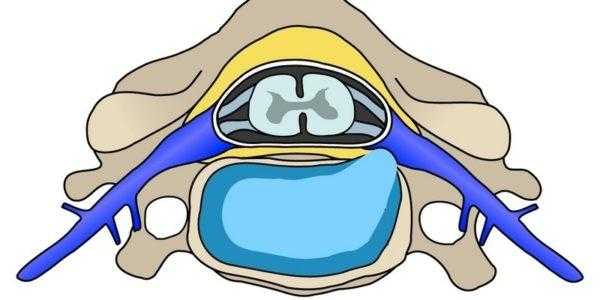 Экструзия диска позвоночника