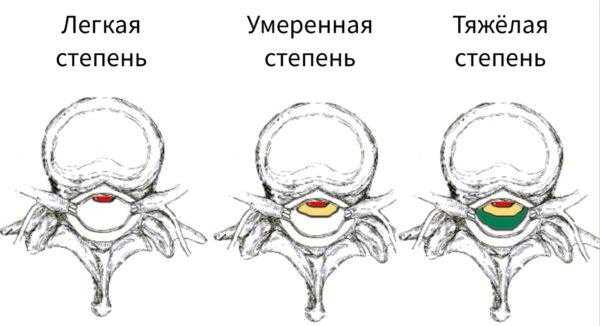 Степени тяжести патологии