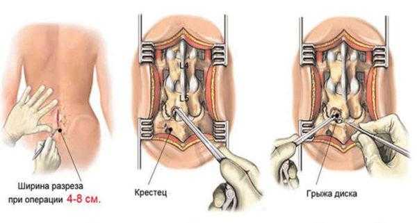 Эндоскопическая дискэктомия