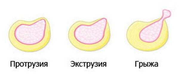 Протрузия, экструзия и грыжа