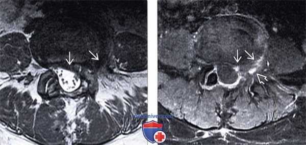 МРТ фораминальной экструзии межпозвонкового диска
