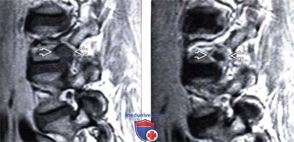 МРТ фораминальной экструзии межпозвонкового диска