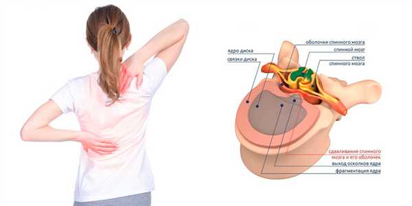 Парамедианная грыжа диска 