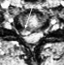 шея-грыжа-акс