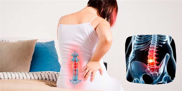 Грыжа пояснично-крестцового отдела