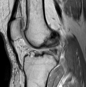 polnyi%cc%86-razryv-pks