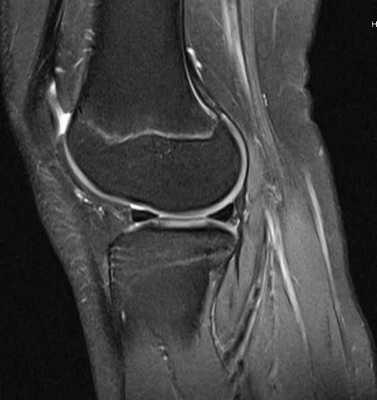 МРТ коленного сустава