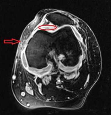 МРТ коленного сустава