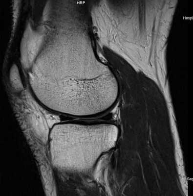 МРТ коленного сустава