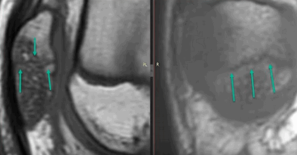 Перелом надколенника на МРТ