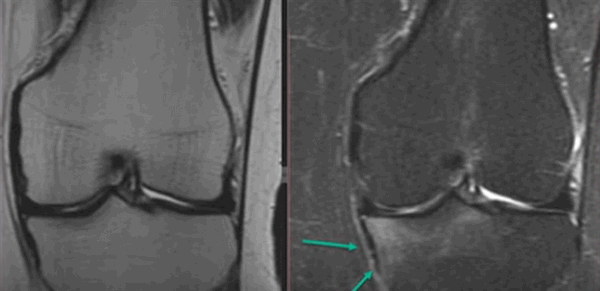 Контузия трабекулярной костной ткани на МРТ