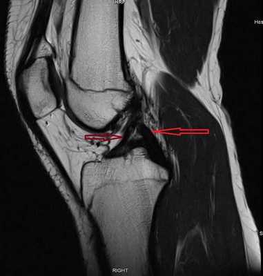 МРТ коленного сустава