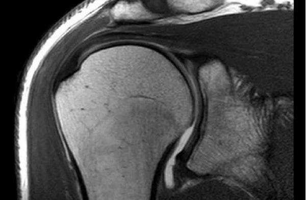 Плечевой сустав на МРТ