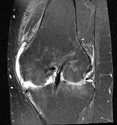 МРТ коленного сустава в прямой проекции