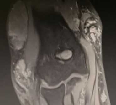 МРТ локтевого сустава в корональной плоскости