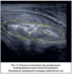 Ультразвуковая диагностика состояния лонного сочленения у женщин