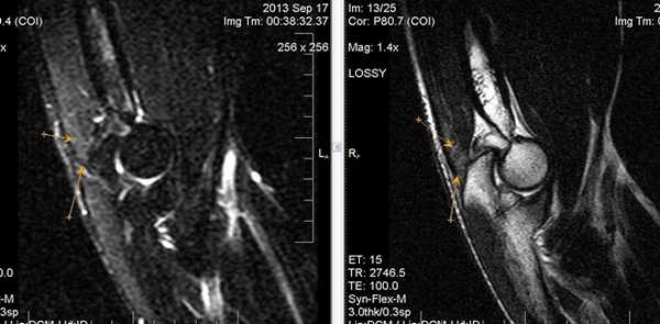 Применение МРТ-диагностики при выявлении патологических изменений локтевого сустава
