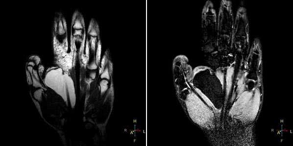 МРТ кисти: когда назначается?
