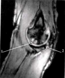 Применение МРТ-диагностики при выявлении патологических изменений локтевого сустава