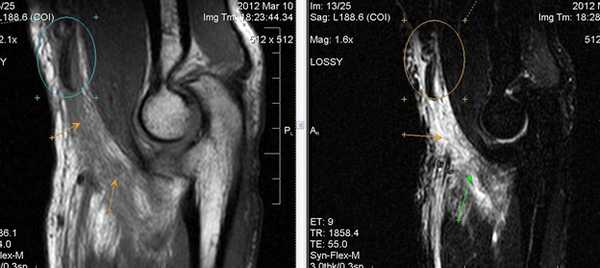 Применение МРТ-диагностики при выявлении патологических изменений локтевого сустава