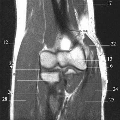Локтевой сустав (МРТ анатомия)