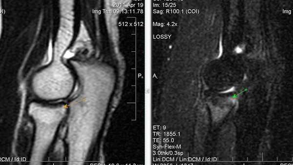 Применение МРТ-диагностики при выявлении патологических изменений локтевого сустава