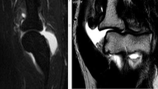 Применение МРТ-диагностики при выявлении патологических изменений локтевого сустава
